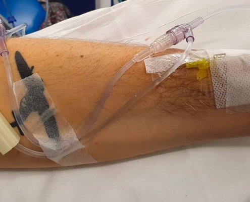 My arm during chemotherapy